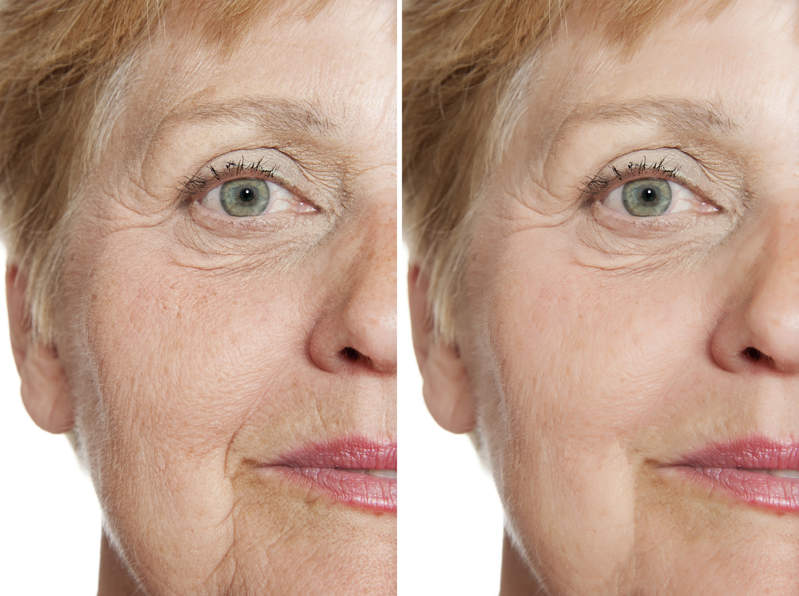 Zdjęcie przed i po liftingu twarzy